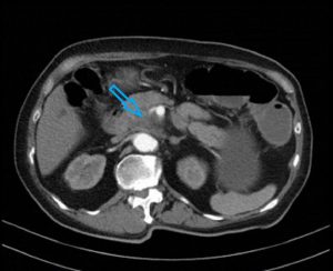 CT scan done at diagnosis showing encasement of superior mesenteric vessels indicated by arrow.