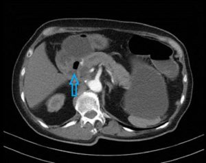 CT scan done at diagnosis showing tumour invading third part of duodenum indicated by arrow.