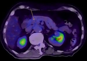 PET scan done after 2 months of erdafitinib treatment with no residual abnormal FDG uptake seen in primary tumour indicated by arrow. PET, positron emission tomography; FDG, fluorodeoxyglucose.